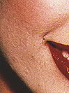 lesbian jodie foster acne medication vanessa williams diaes and adult acne